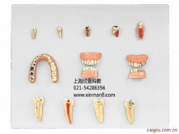 牙齿病变系列模型